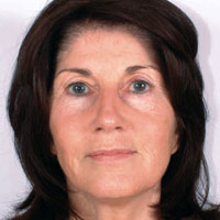 Female before micropigmentation