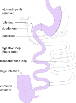 Duodenal Switch Operation