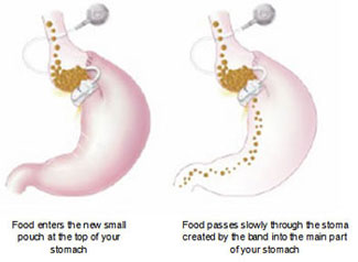 Gastric Band Illustration