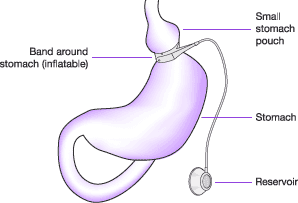 Adjustable Gastric Band Operation