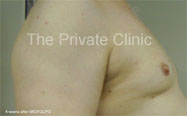 Gynaecomastia following VASER liposuction