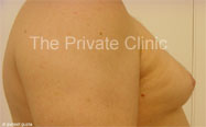 Man boobs, moobs before treatment