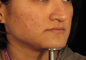 Acne after Dermaroller treatment