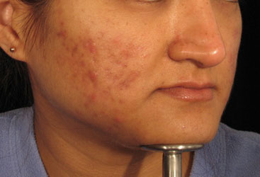 Acne before Dermaroller treatment