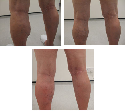 Male patient treated for varicose veins with endovenous laser ablation.