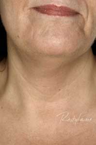 Neck before treatment with RESTYLANE® Vital