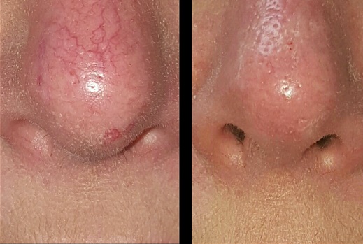 Before and after nose treatment for thread veins using Thermavein