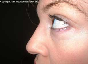 Female nose reshaping after Perlane dermal filler treatment