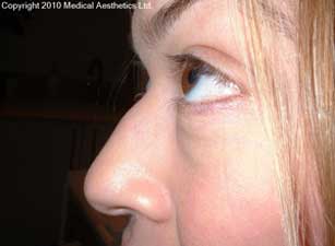 Female nose before Dermal filler treatment