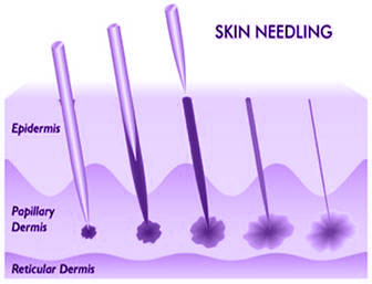 Medical Skin Needline Mechanism of Action