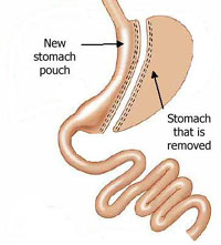 Sleeve Gastrectomy Operation