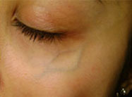 Thread veins by eye before treatment