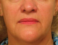 Face 2½ months after Titan treatment