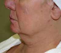 Face before Titan treatment