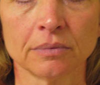 Face before Titan treatment