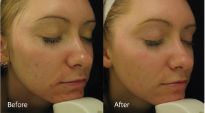 before and after on Acne after using the dermalux