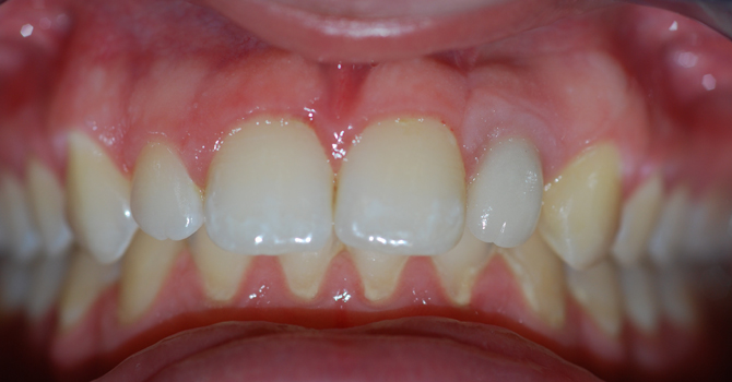 The final result of having Dental Implants