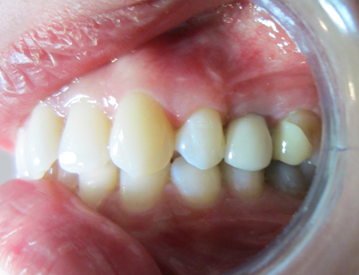 The result of having a Dental Implant fitted