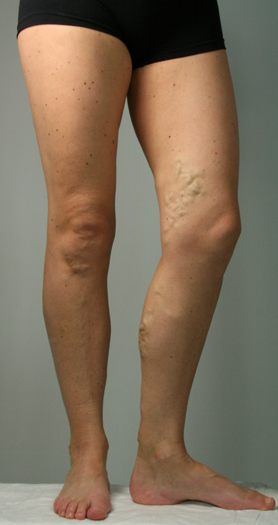 Left leg of a female with varicose veins before Endovenous Laser Ablation treatment