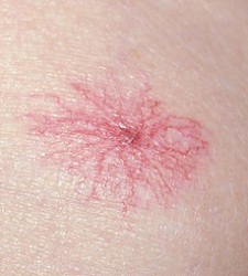 Spider Angioma