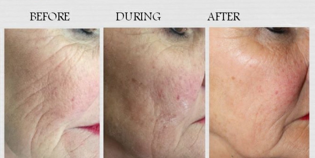 Xela-Rederm-Cheek-BA.jpg