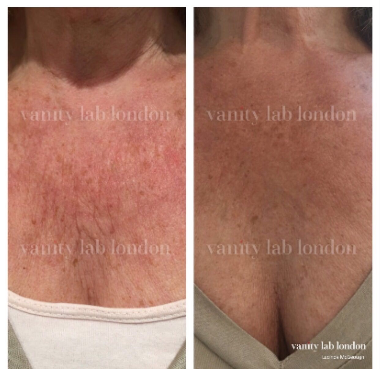 Xela-Rederm-Decolletage-BA.jpg