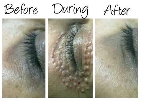 Xela-Rederm-before-and-after-eye