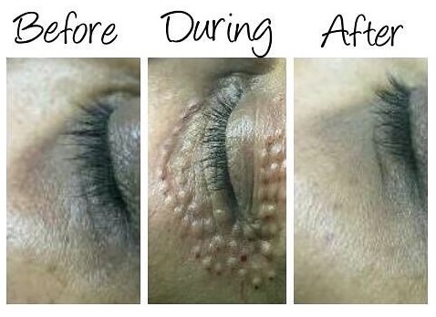 Xela-Rederm-Eyes-BA.jpg