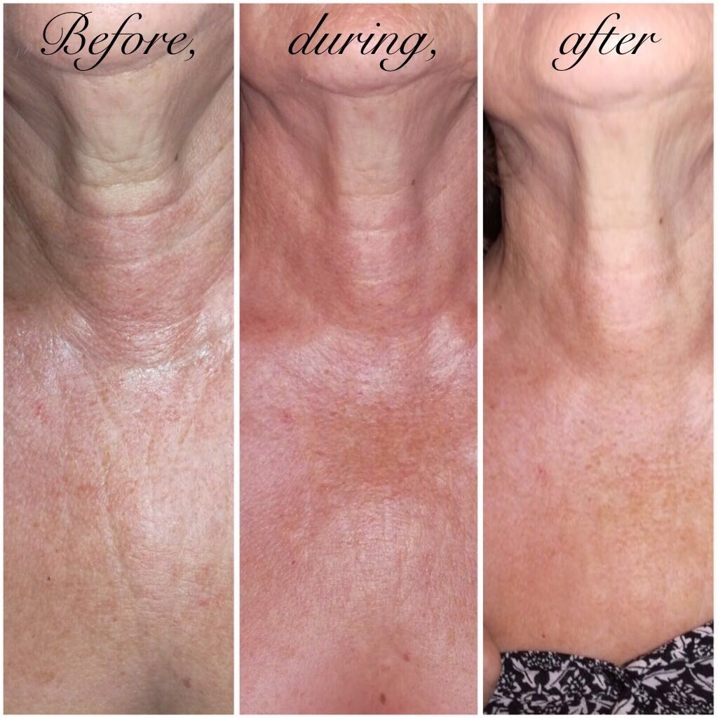 Xela-Rederm-Neck-BA.jpg