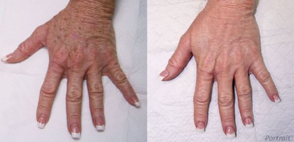 Before and After Plasma Skin Resurfacing Image