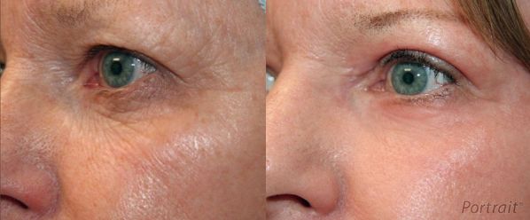 Before and After Plasma Skin Resurfacing Images
