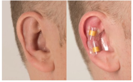 earFold Test