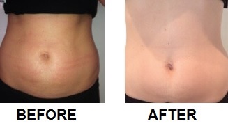 Before and after lipoglaze treatment