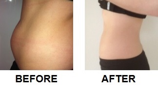 Before and after lipoglaze treatment